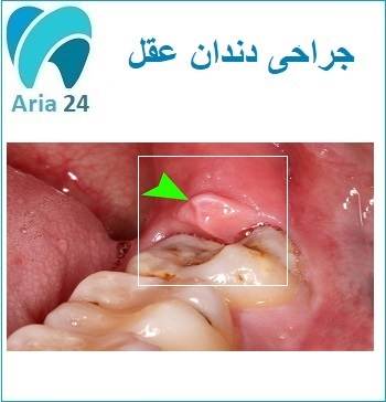 بهترین متخصص جراحی دندان عقل در غرب تهران 